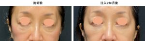 Before treatment: close-up of a woman's eyes showing under-eye bags and hollow lower lids. 輪郭未改善。