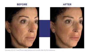 Before (left) and after (right) photos of a woman showing smoother skin and reduced facial wrinkles after cosmetic treatment, taken 4 months after the first session.