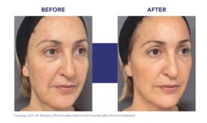 Before and after facial treatment: left image shows uneven skin tone and fine lines; right image shows smoother, more even skin with reduced lines across the cheeks and under-eye area.