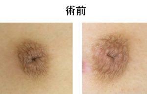 　乳首　陥没 