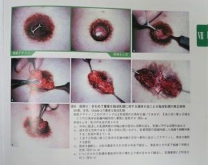 　乳首　陥没 陥没乳頭の治療 | みかこクリニック -Mikako Clinic-（形成外科/美容外科/美容皮膚科）一宮駅東口徒歩１分